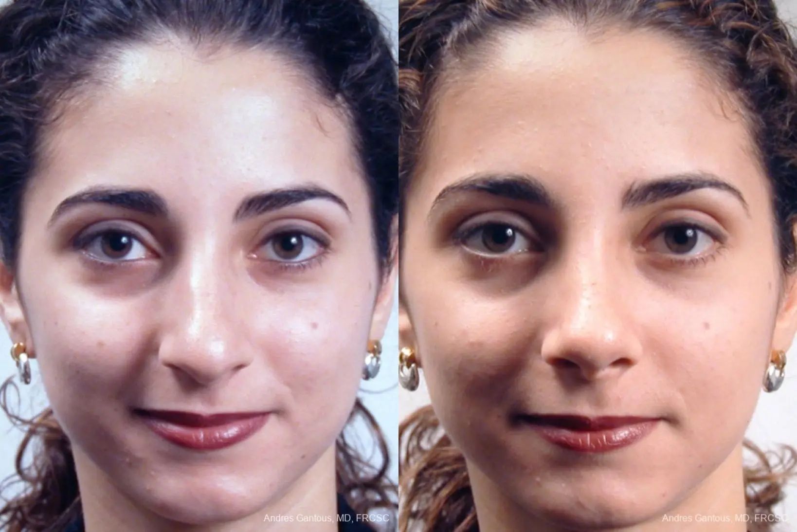 Rhinoplasty: Patient 13 - Before and After  