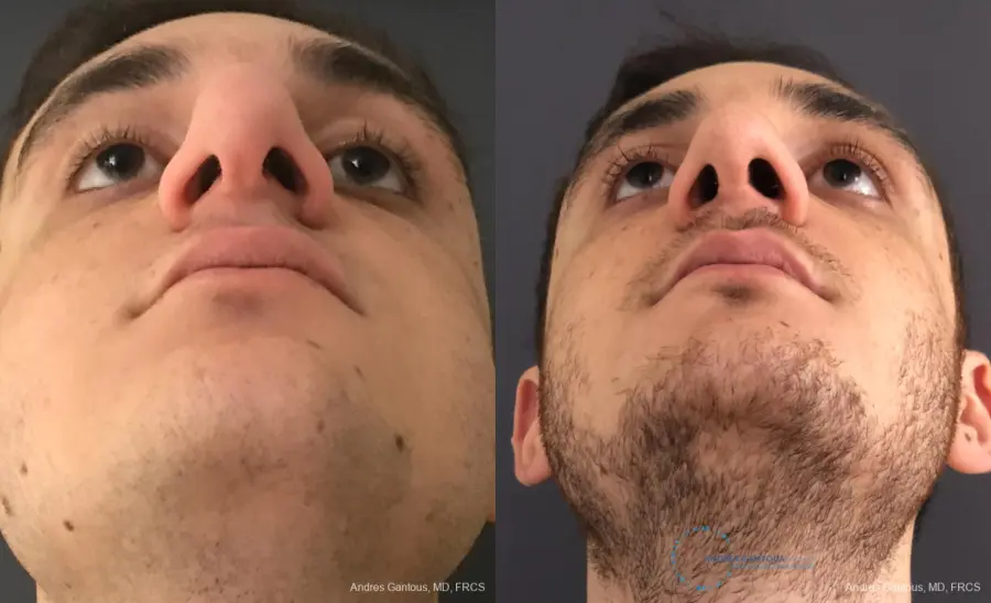 Rhinoplasty: Patient 81 - Before and After 2