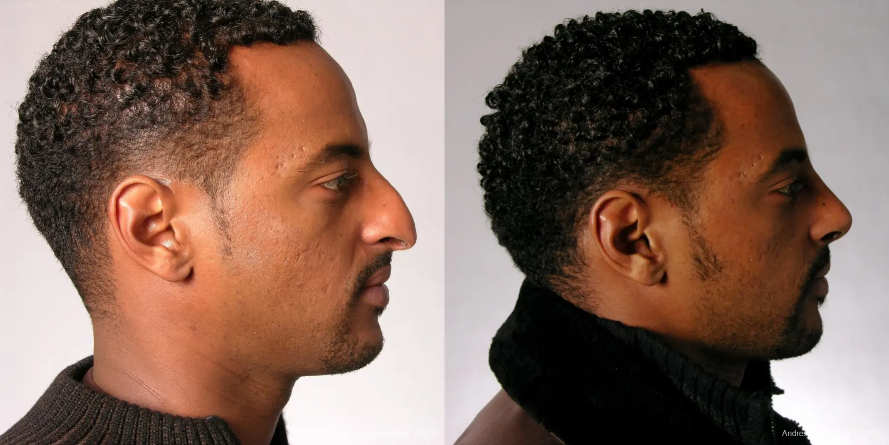 Rhinoplasty: Patient 30 - Before and After 3