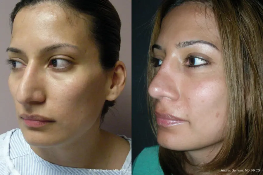 Rhinoplasty: Patient 56 - Before and After 4
