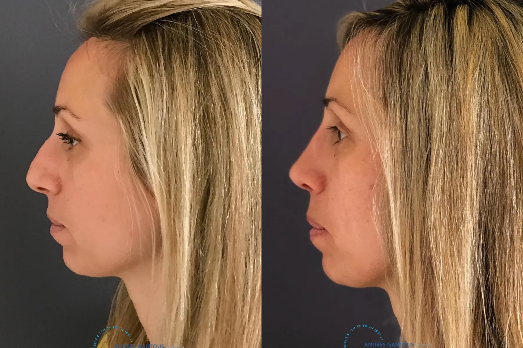 Rhinoplasty: Patient 71 - Before and After 5