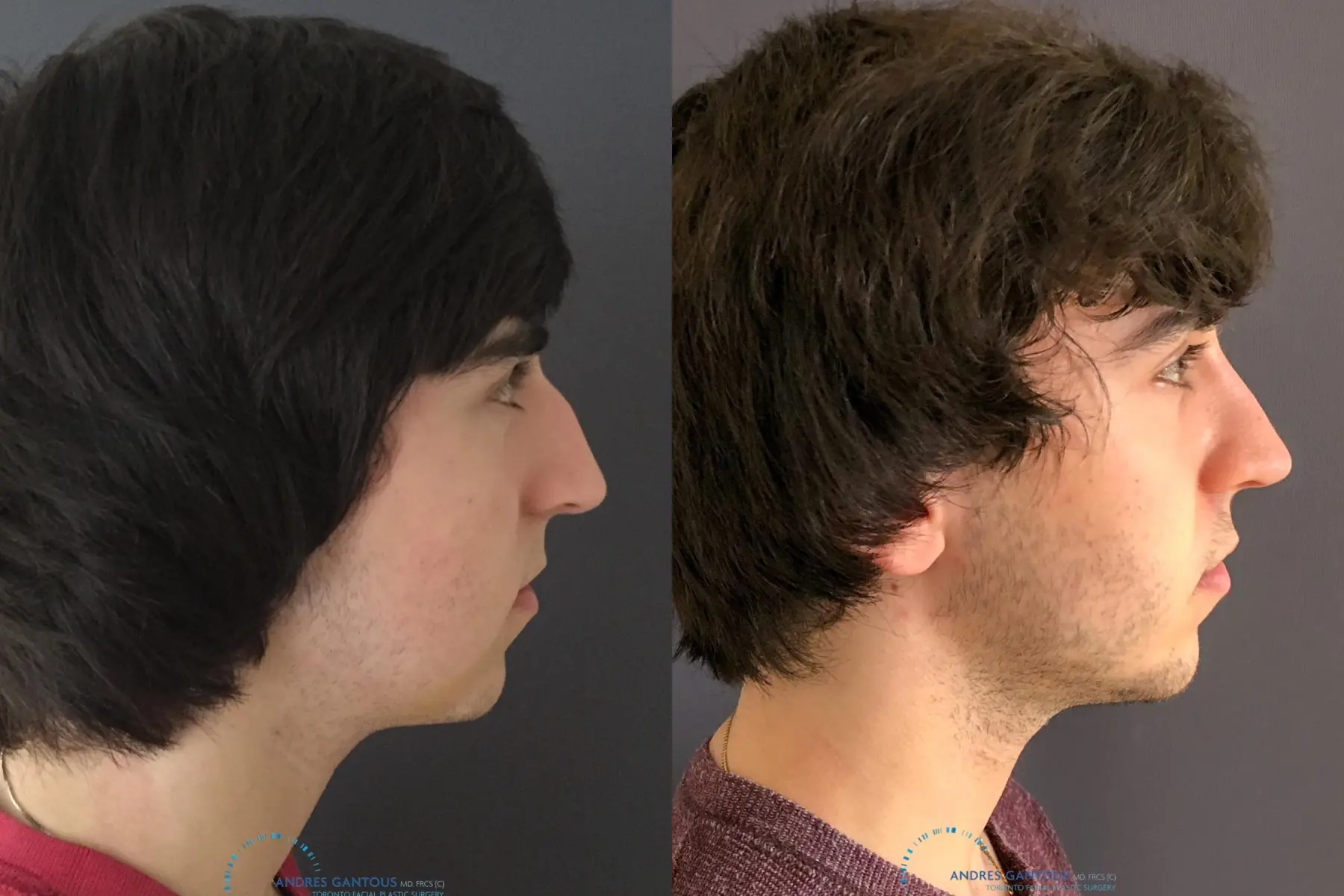 Rhinoplasty: Patient 65 - Before and After 5