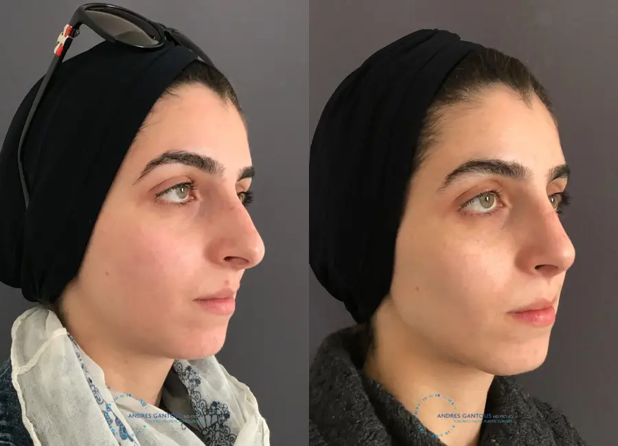 Rhinoplasty: Patient 58 - Before and After 3