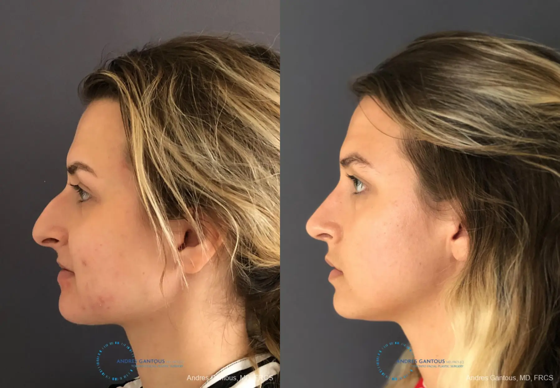 Rhinoplasty: Patient 88 - Before and After 6