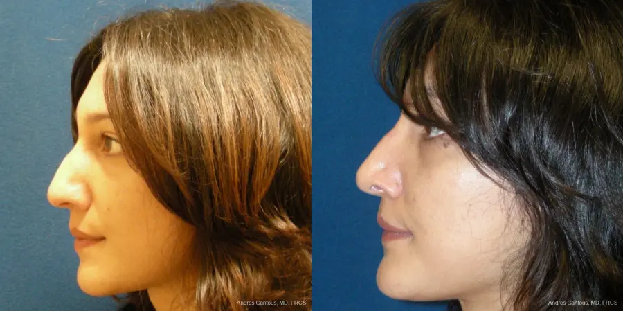 Rhinoplasty: Patient 42 - Before and After 4