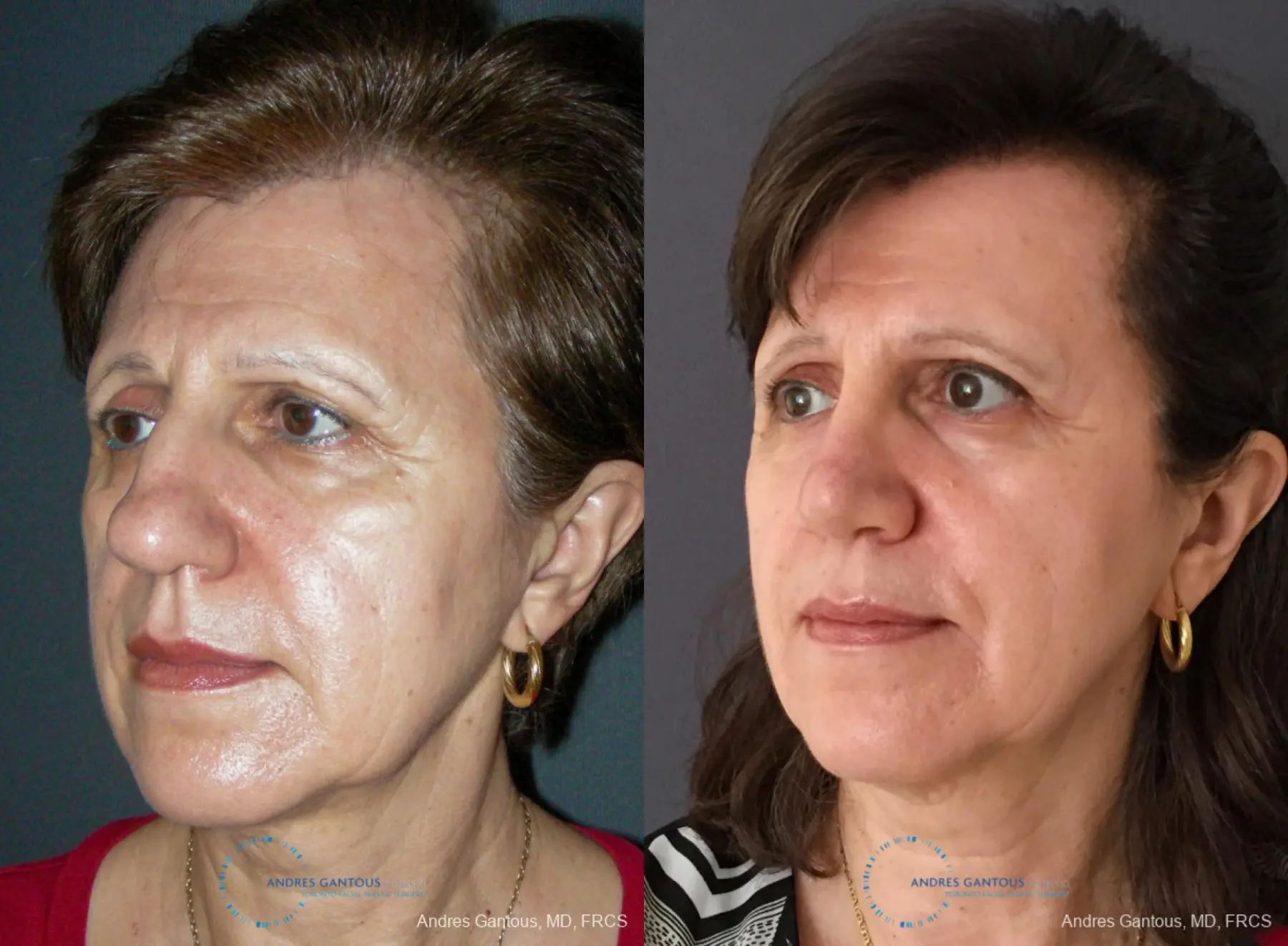 Rhinoplasty: Patient 95 - Before and After 4