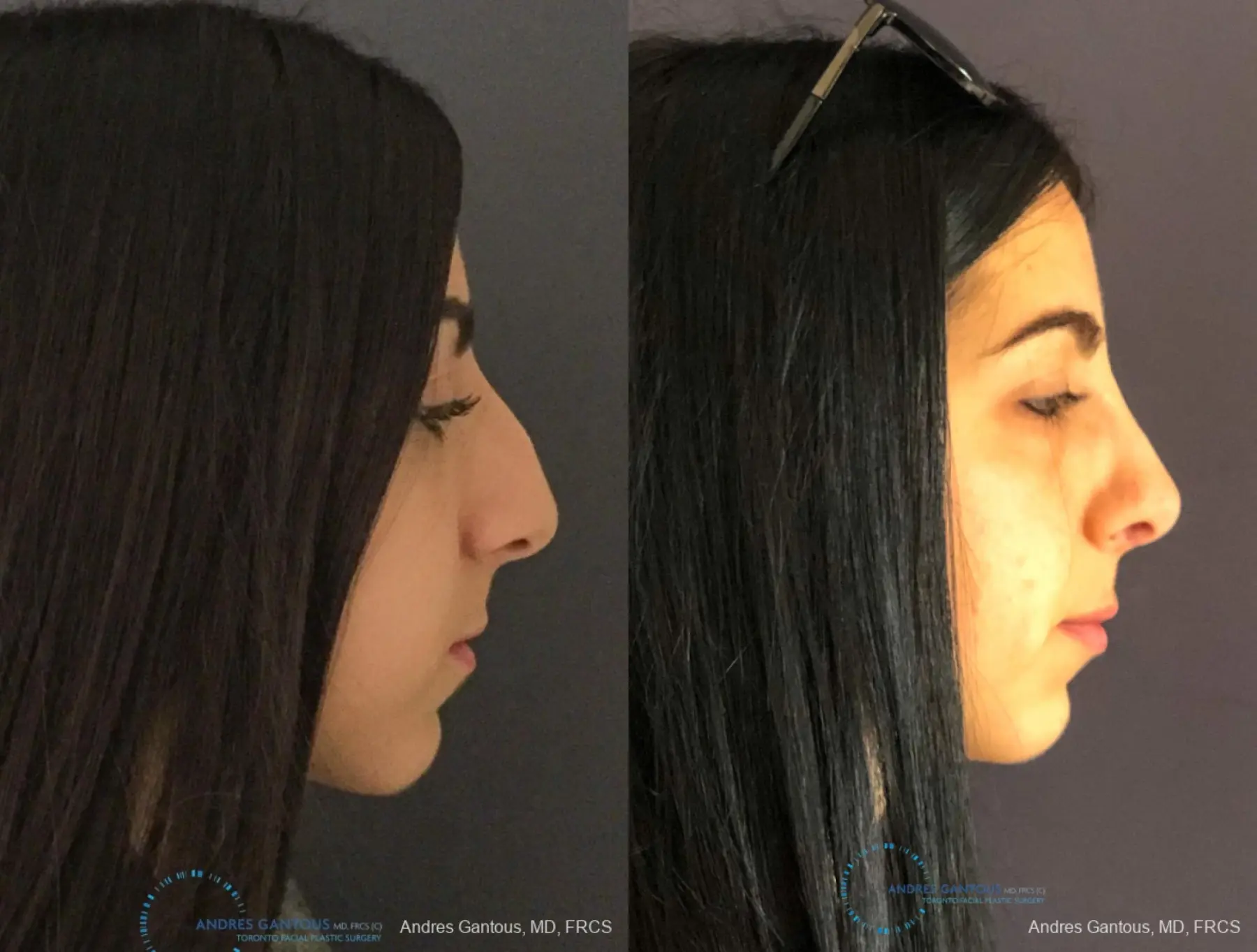 Rhinoplasty: Patient 85 - Before and After 5