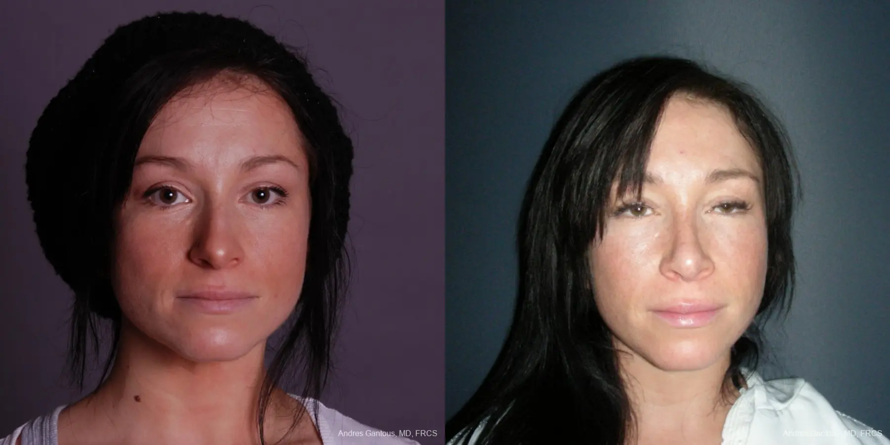 Rhinoplasty: Patient 46 - Before and After  