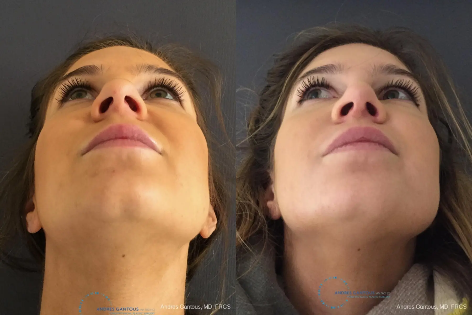 Rhinoplasty: Patient 77 - Before and After 2