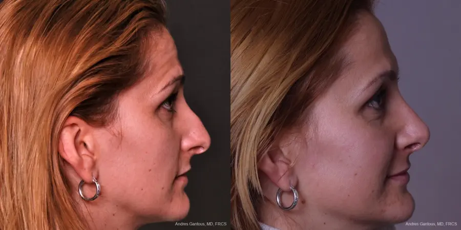 Rhinoplasty: Patient 34 - Before and After 4