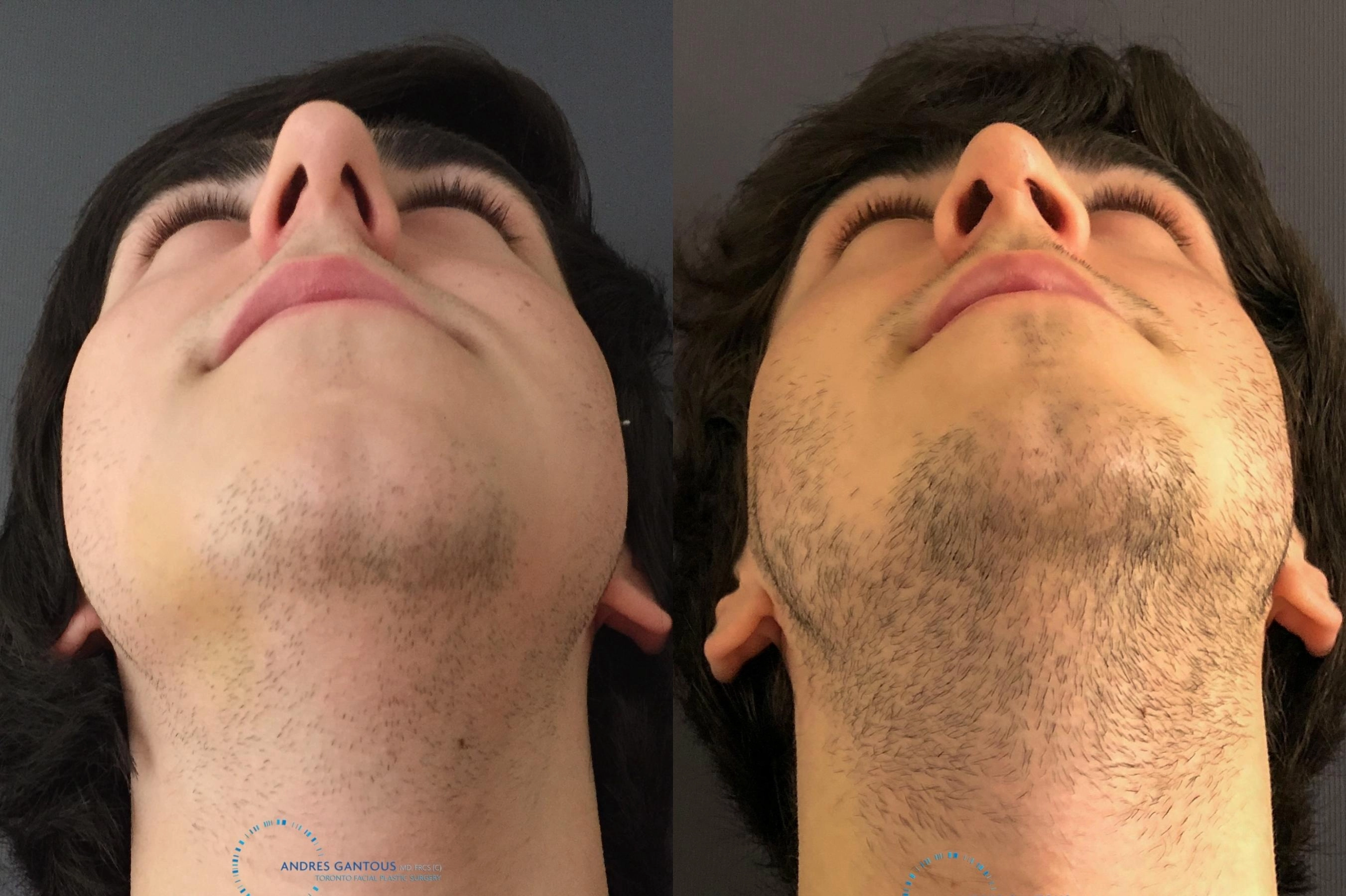 Rhinoplasty - Thumbnail 2