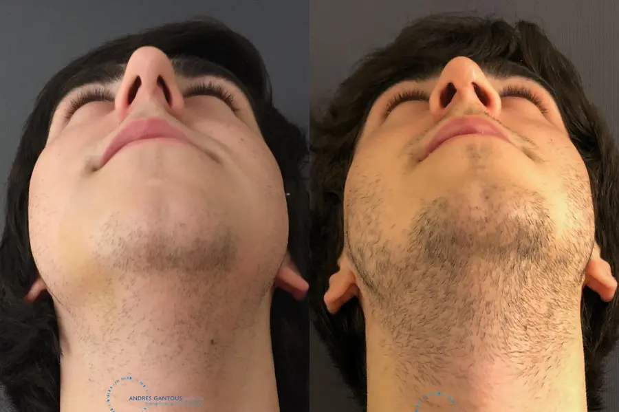 Rhinoplasty: Patient 67 - Before and After 2