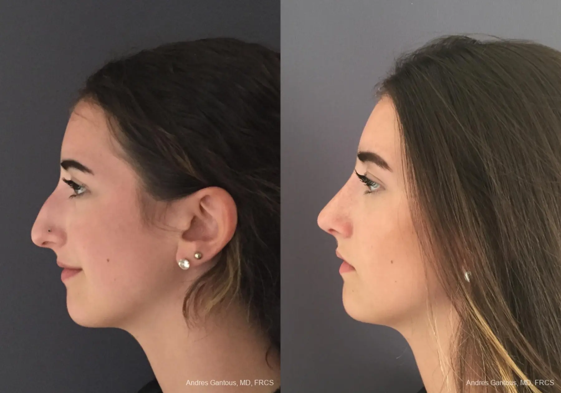 Rhinoplasty: Patient 95 - Before and After 6