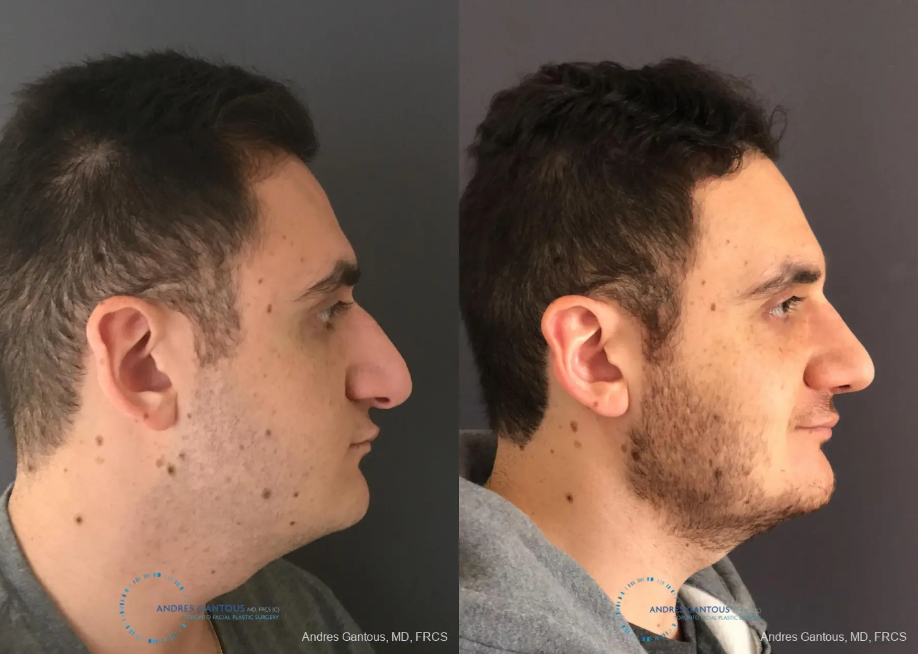 Rhinoplasty: Patient 81 - Before and After 4