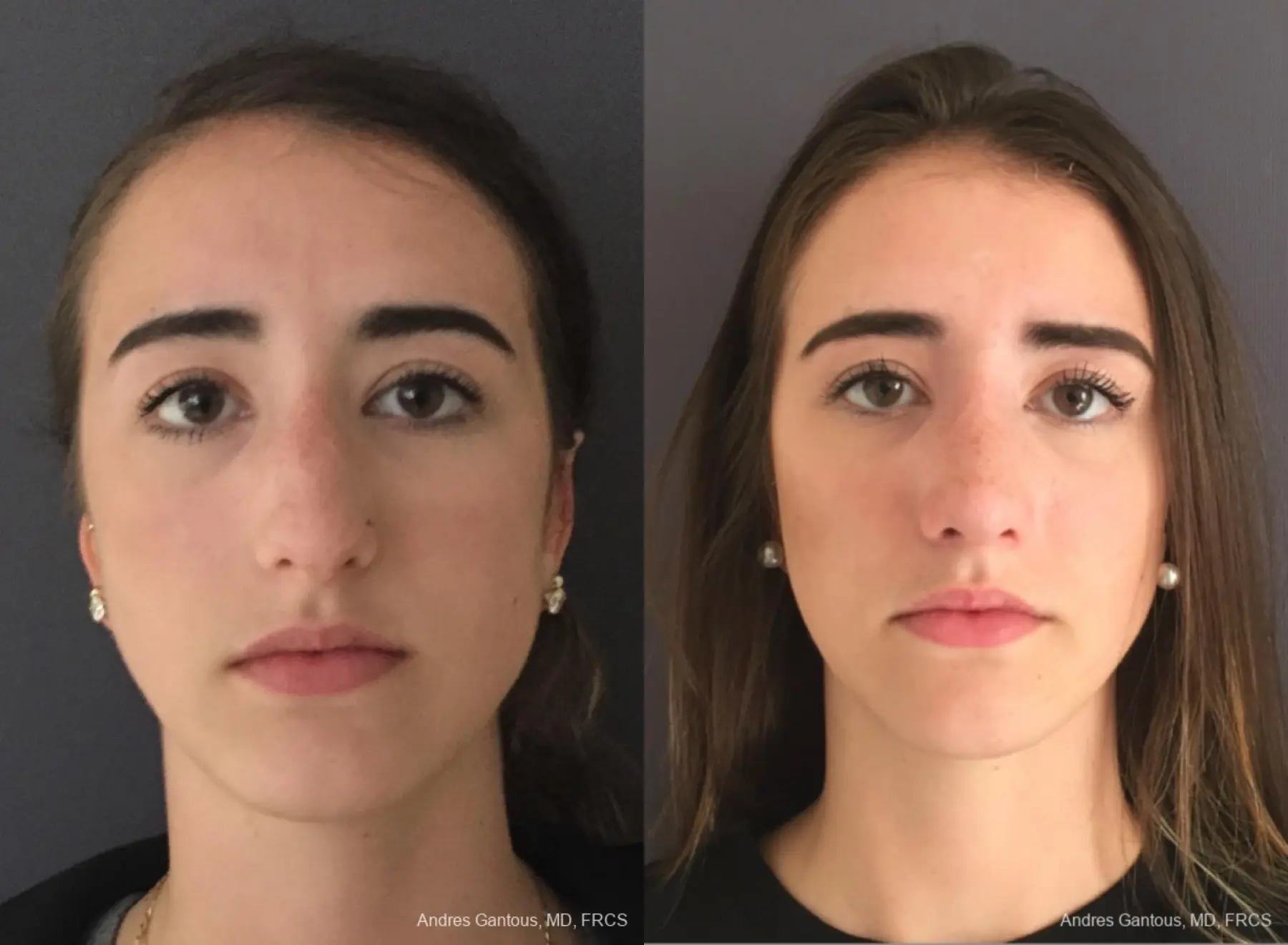 Rhinoplasty: Patient 95 - Before and After  
