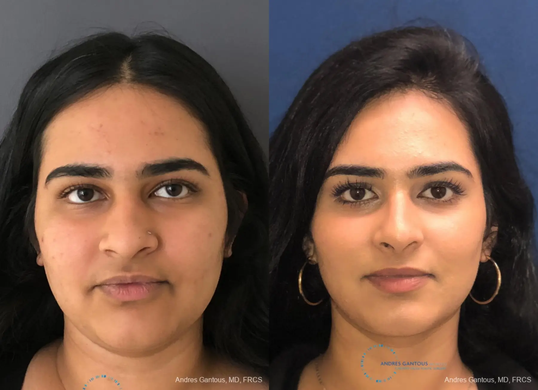 Rhinoplasty: Patient 84 - Before and After  