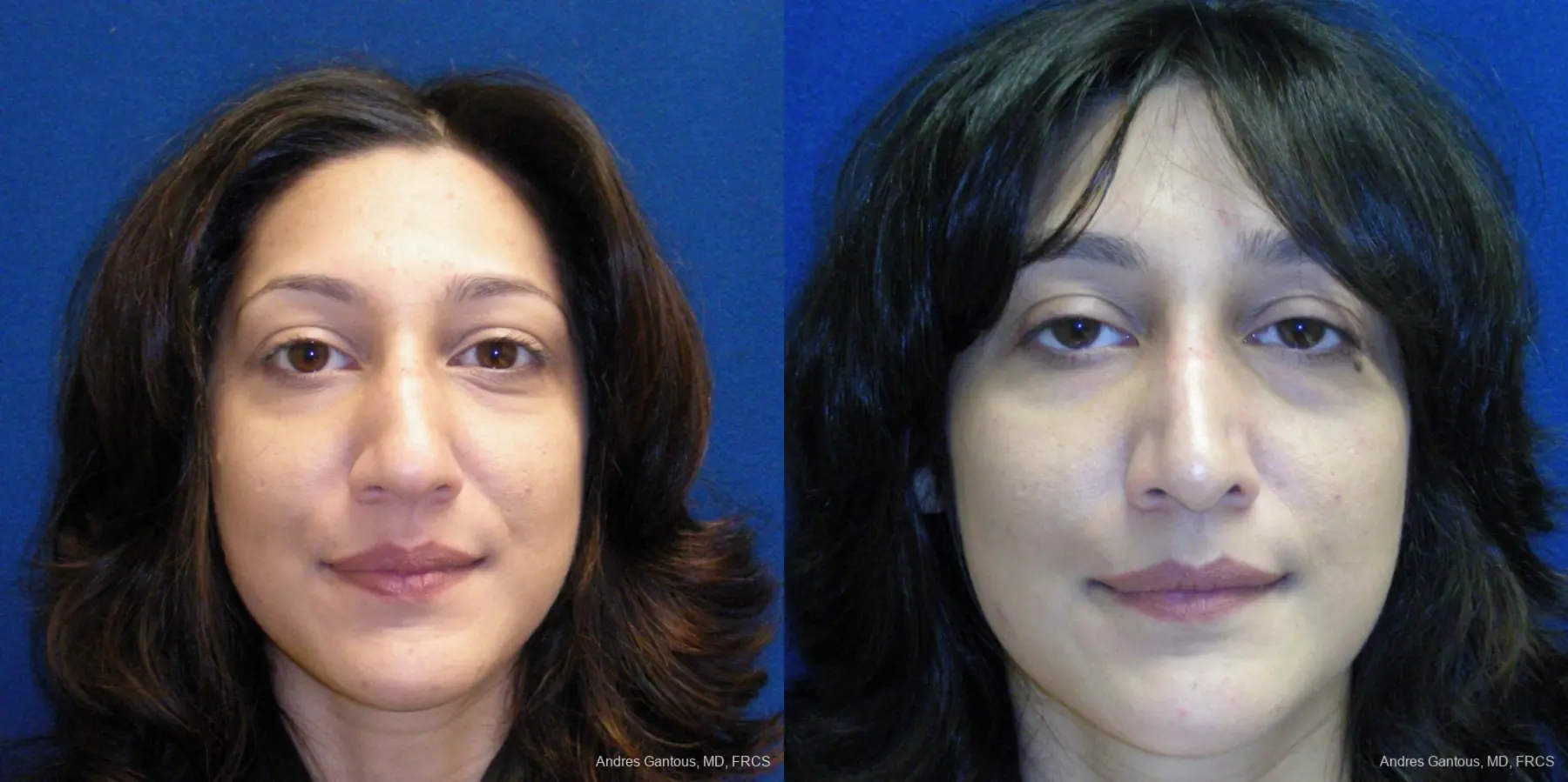 Rhinoplasty: Patient 42 - Before and After 1