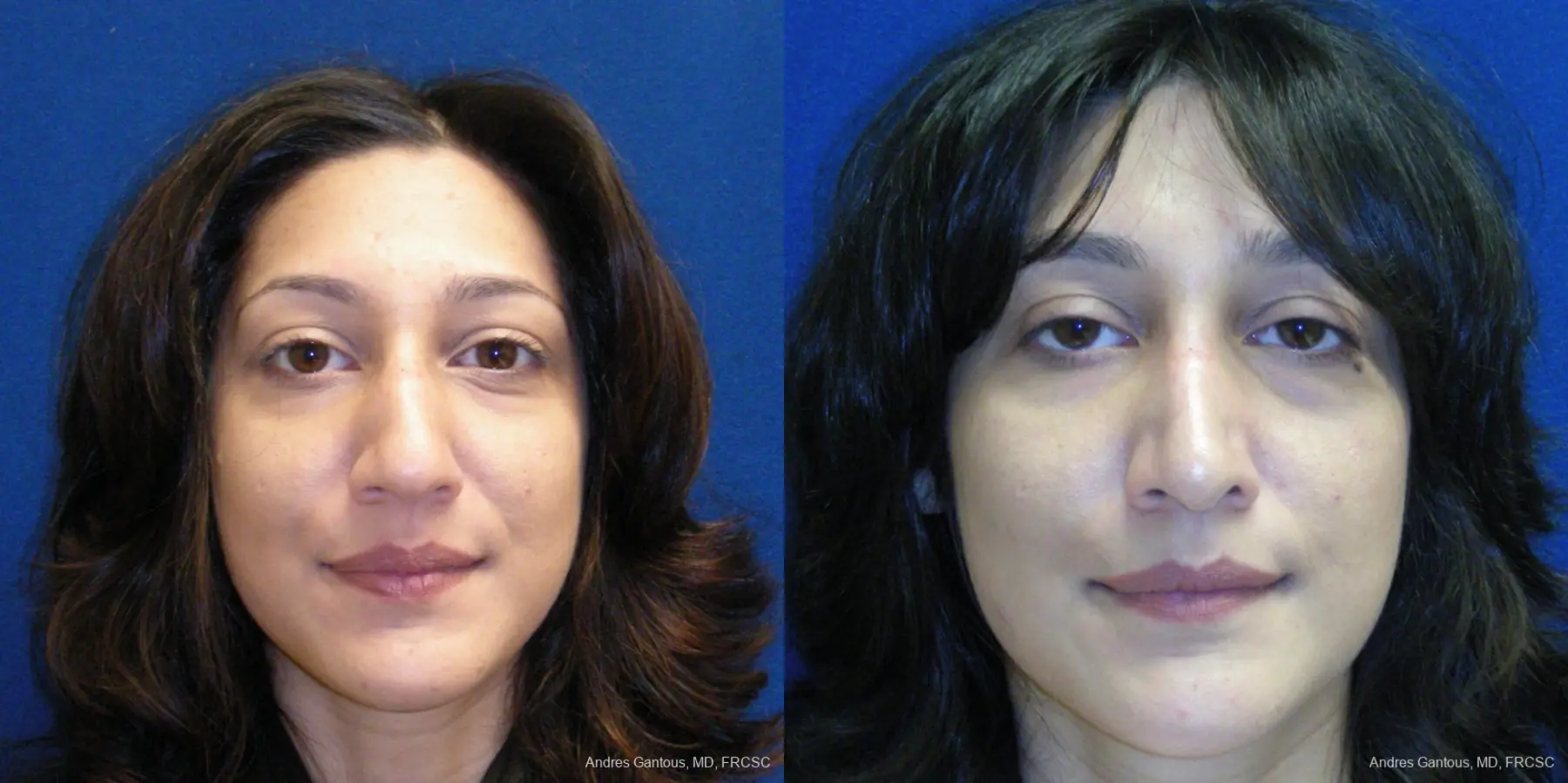 Rhinoplasty: Patient 42 - Before and After  