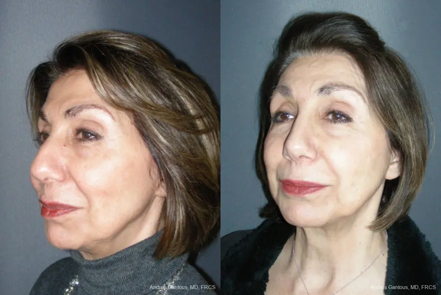 Rhinoplasty: Patient 53 - Before and After 2