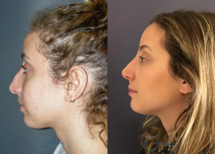 Rhinoplasty: Patient 72 - Before and After 6