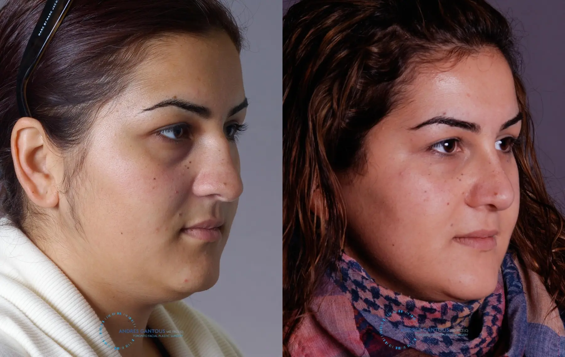 Rhinoplasty: Patient 67 - Before and After 2