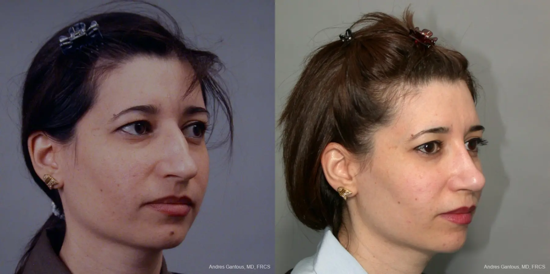 Rhinoplasty: Patient 41 - Before and After 3