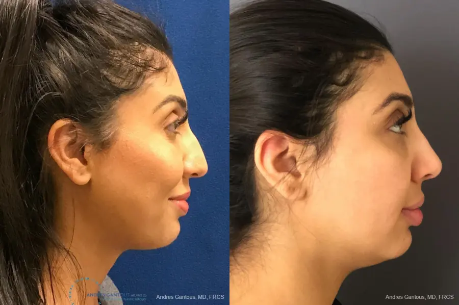 Rhinoplasty: Patient 75 - Before and After 5