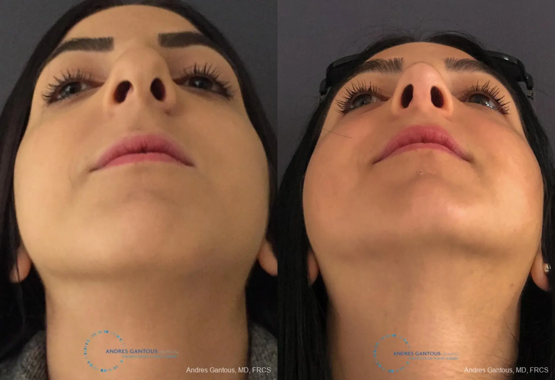 Rhinoplasty: Patient 83 - Before and After 2