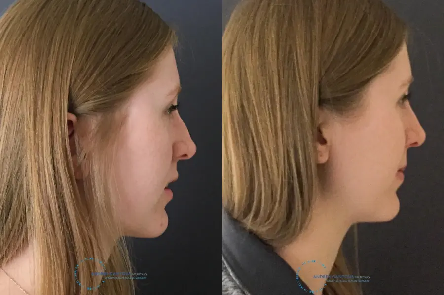 Rhinoplasty: Patient 26 - Before and After 6