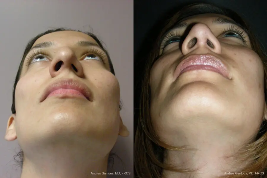 Rhinoplasty: Patient 56 - Before and After 6