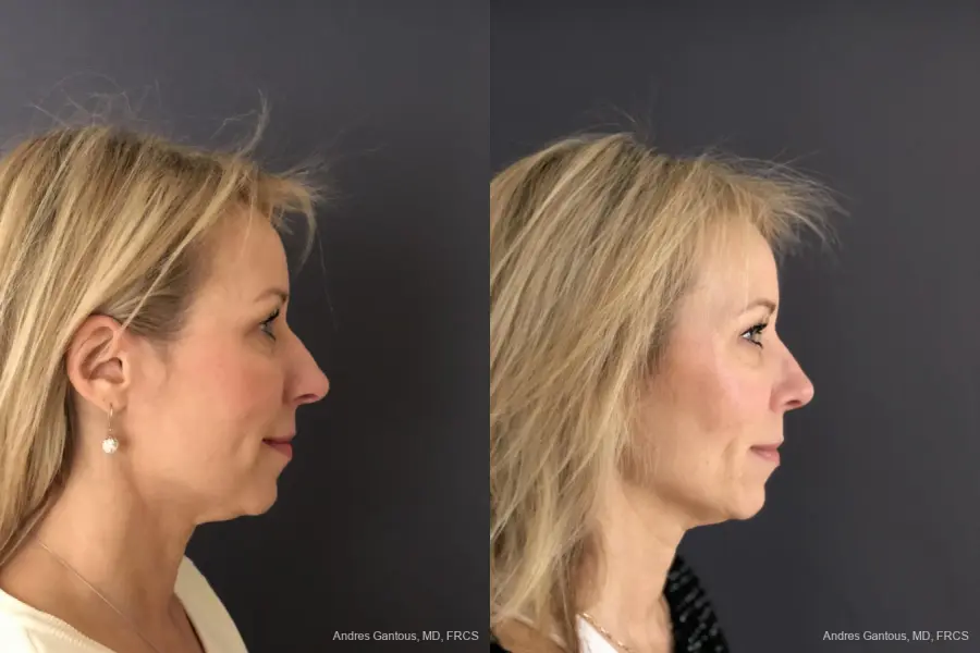 Rhinoplasty: Patient 15 - Before and After 5