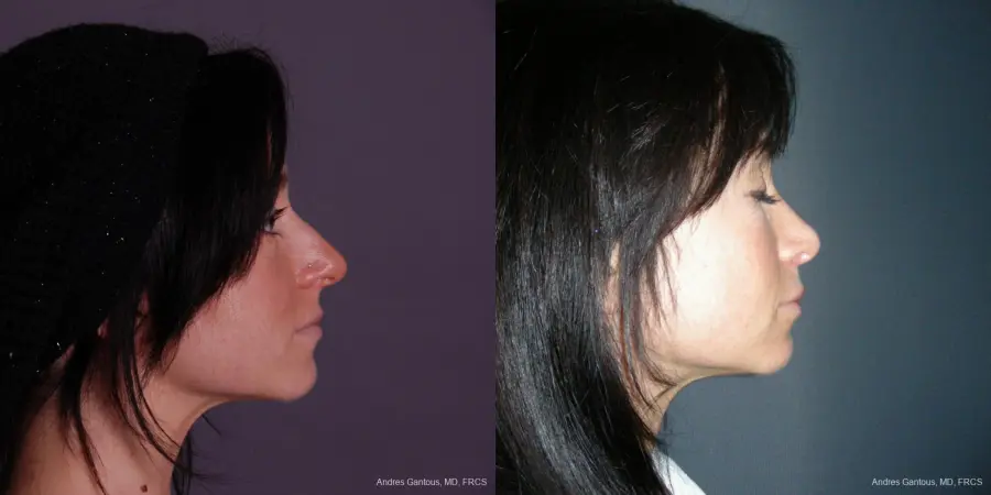 Rhinoplasty: Patient 46 - Before and After 3