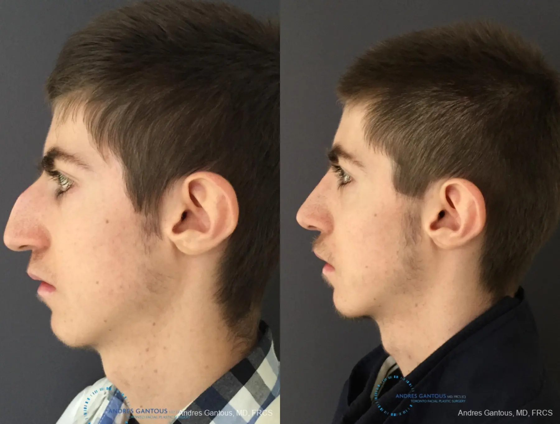 Rhinoplasty: Patient 80 - Before and After 4