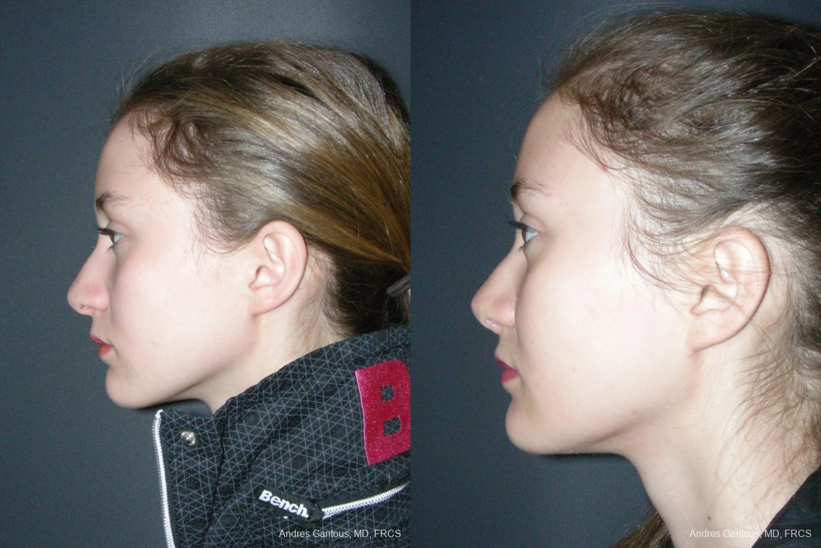 Rhinoplasty - Thumbnail 5