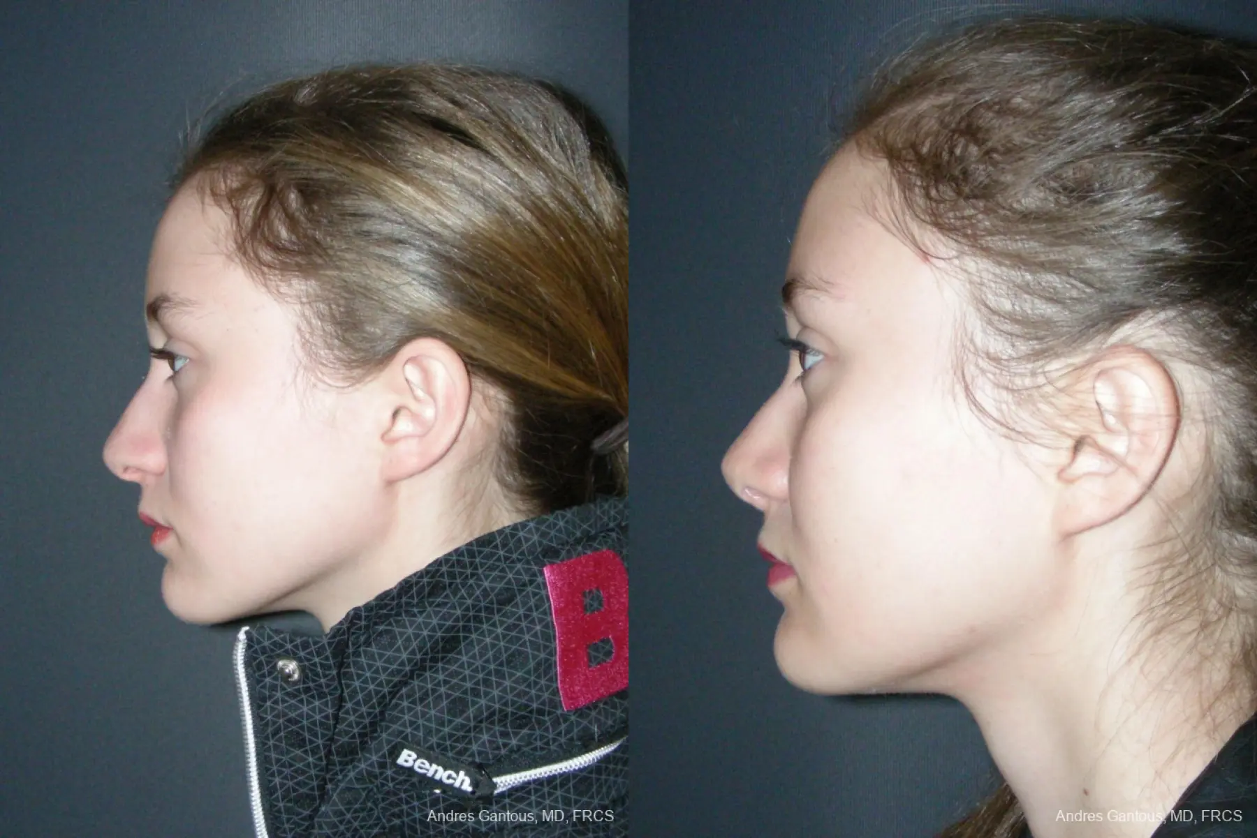 Rhinoplasty: Patient 55 - Before and After 5