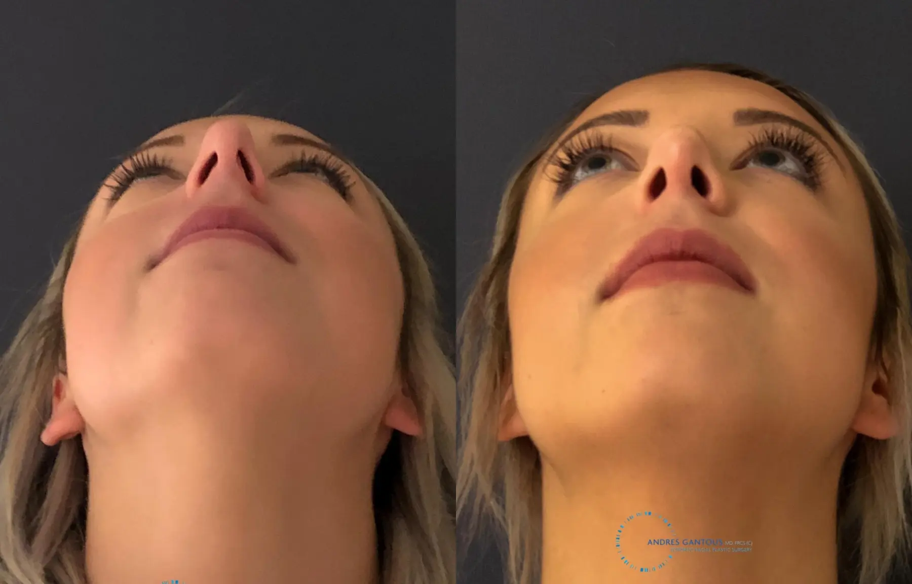 Rhinoplasty: Patient 69 - Before and After 2
