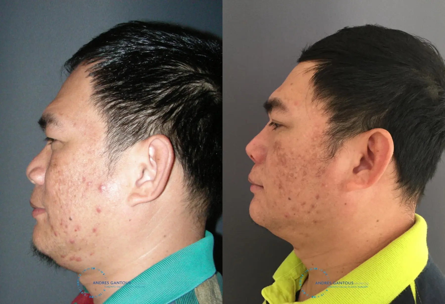 Rhinoplasty: Patient 61 - Before and After 6
