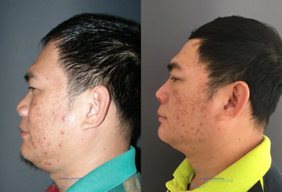 Rhinoplasty: Patient 63 - Before and After 6