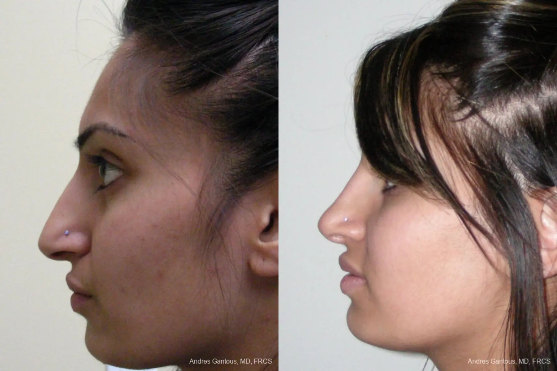 Rhinoplasty: Patient 28 - Before and After 4