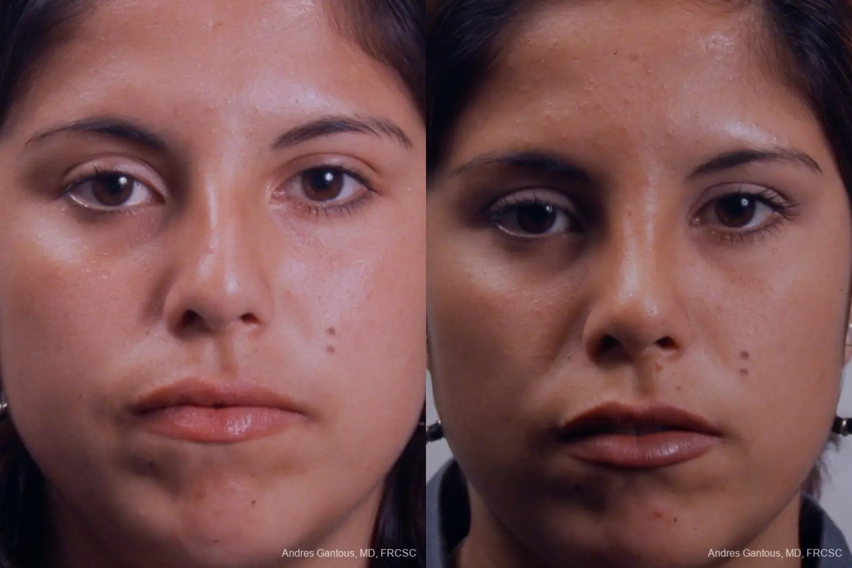 Rhinoplasty: Patient 19 - Before and After  