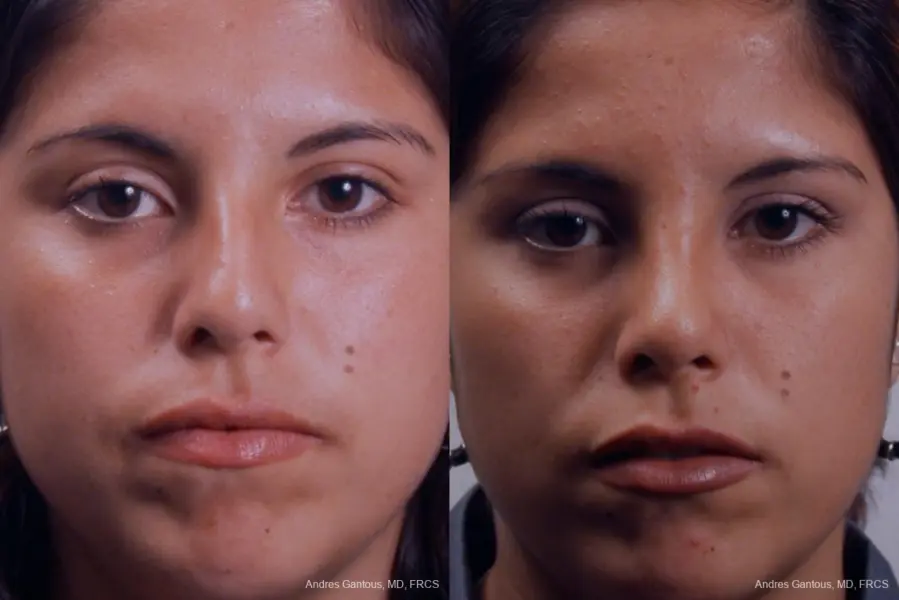Rhinoplasty: Patient 19 - Before and After 1
