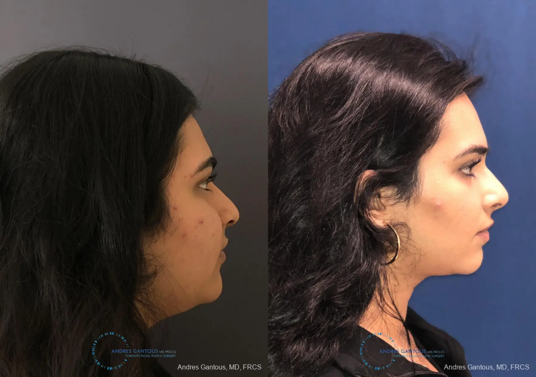 Rhinoplasty: Patient 84 - Before and After 5