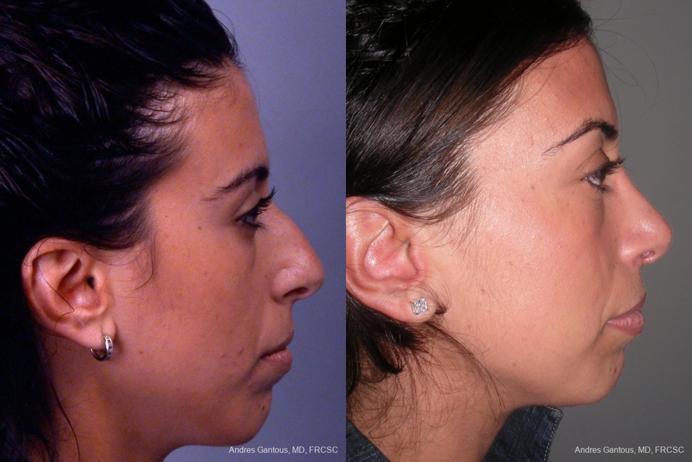 Rhinoplasty - Thumbnail 2