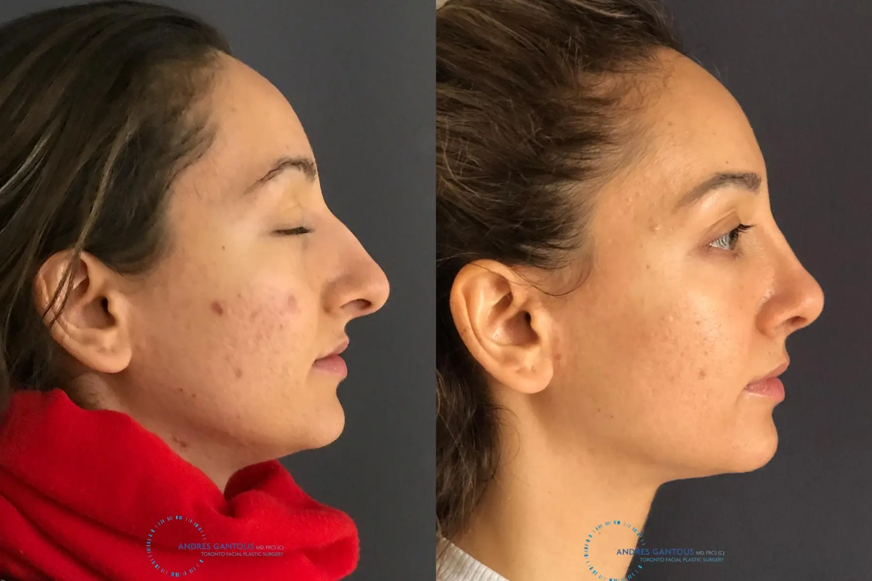 Rhinoplasty: Patient 59 - Before and After 5