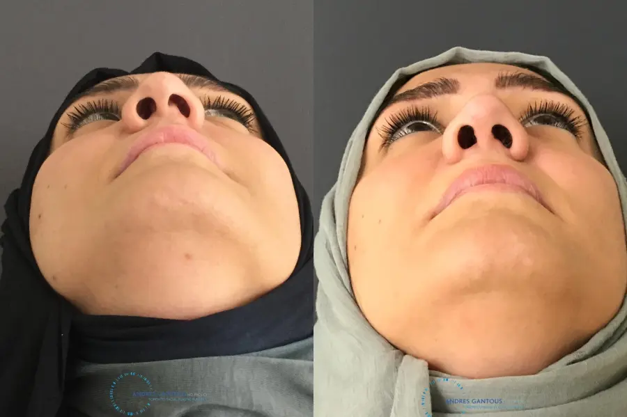 Rhinoplasty: Patient 5 - Before and After 2