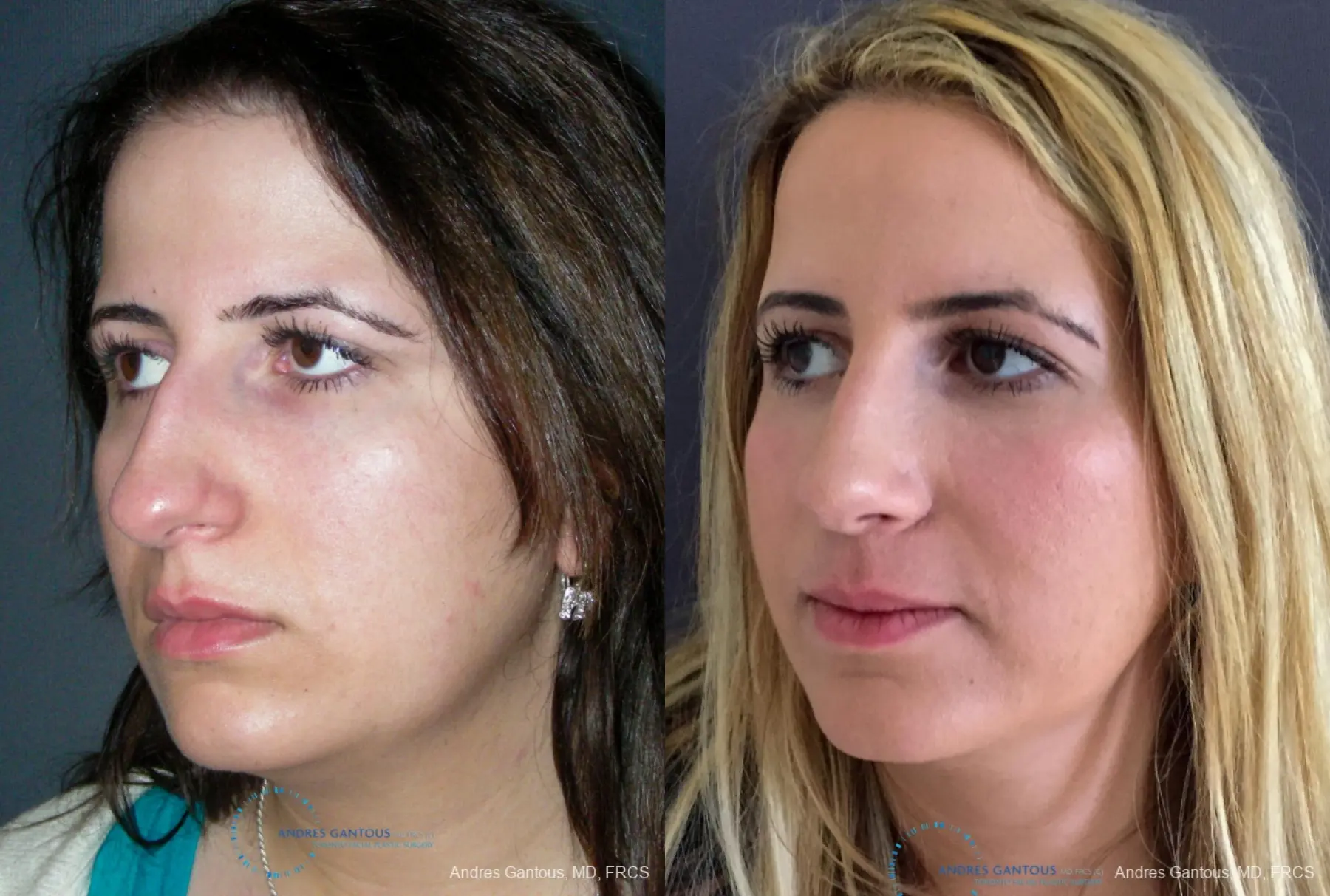 Rhinoplasty: Patient 92 - Before and After 4