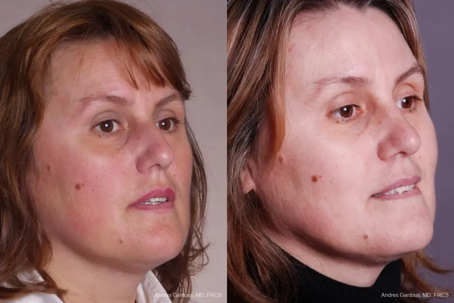 Rhinoplasty: Patient 40 - Before and After 2