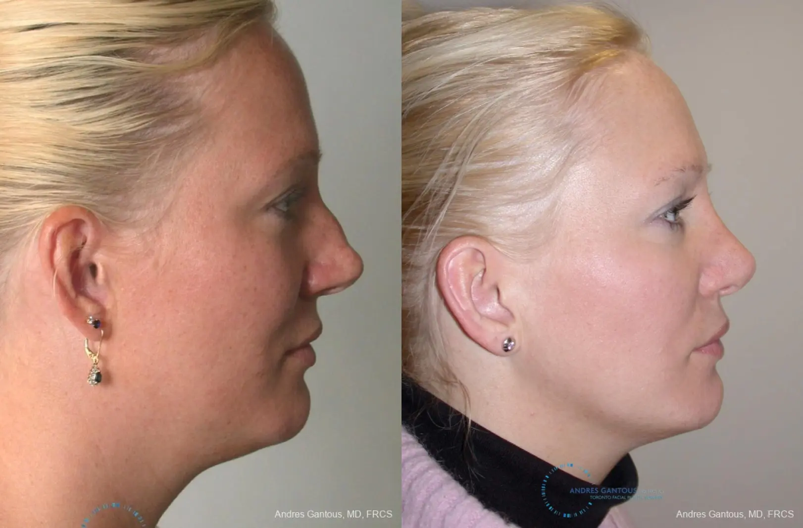 Rhinoplasty: Patient 92 - Before and After 5