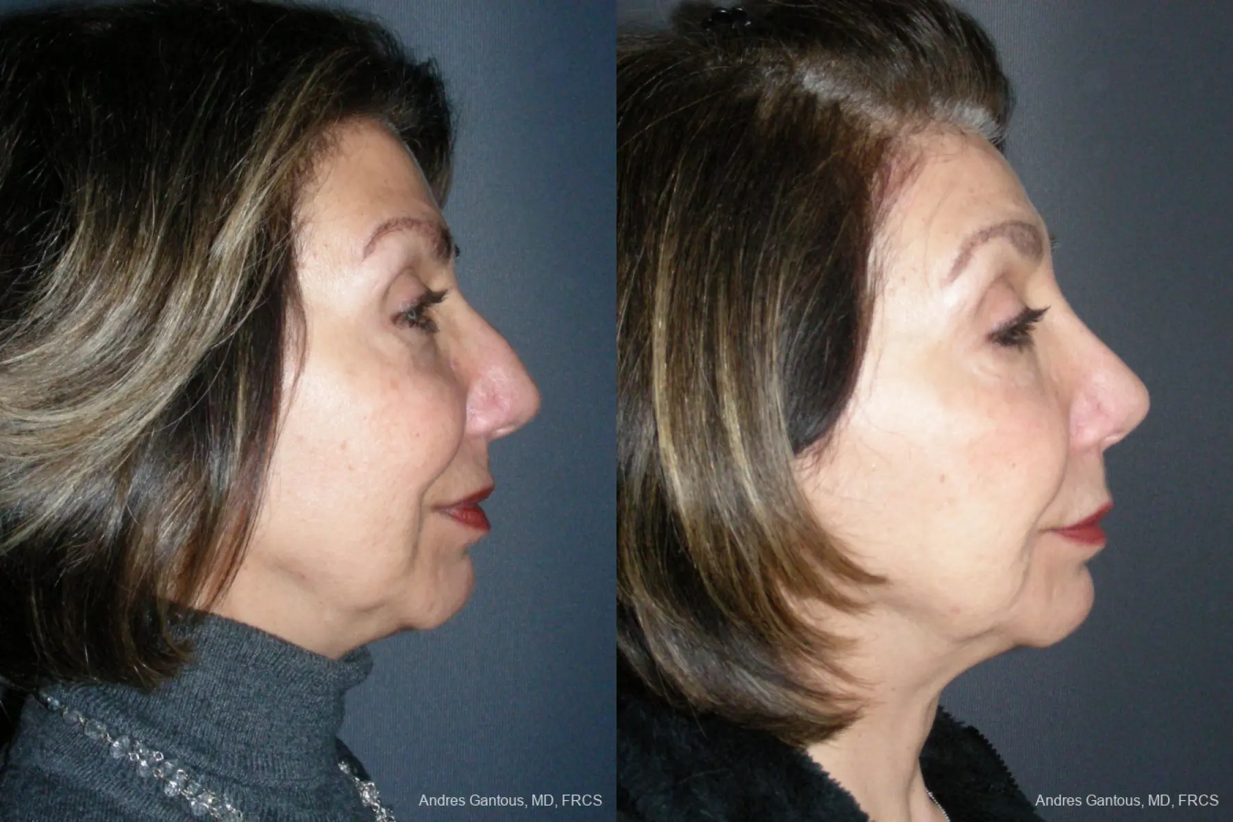 Rhinoplasty: Patient 53 - Before and After 5