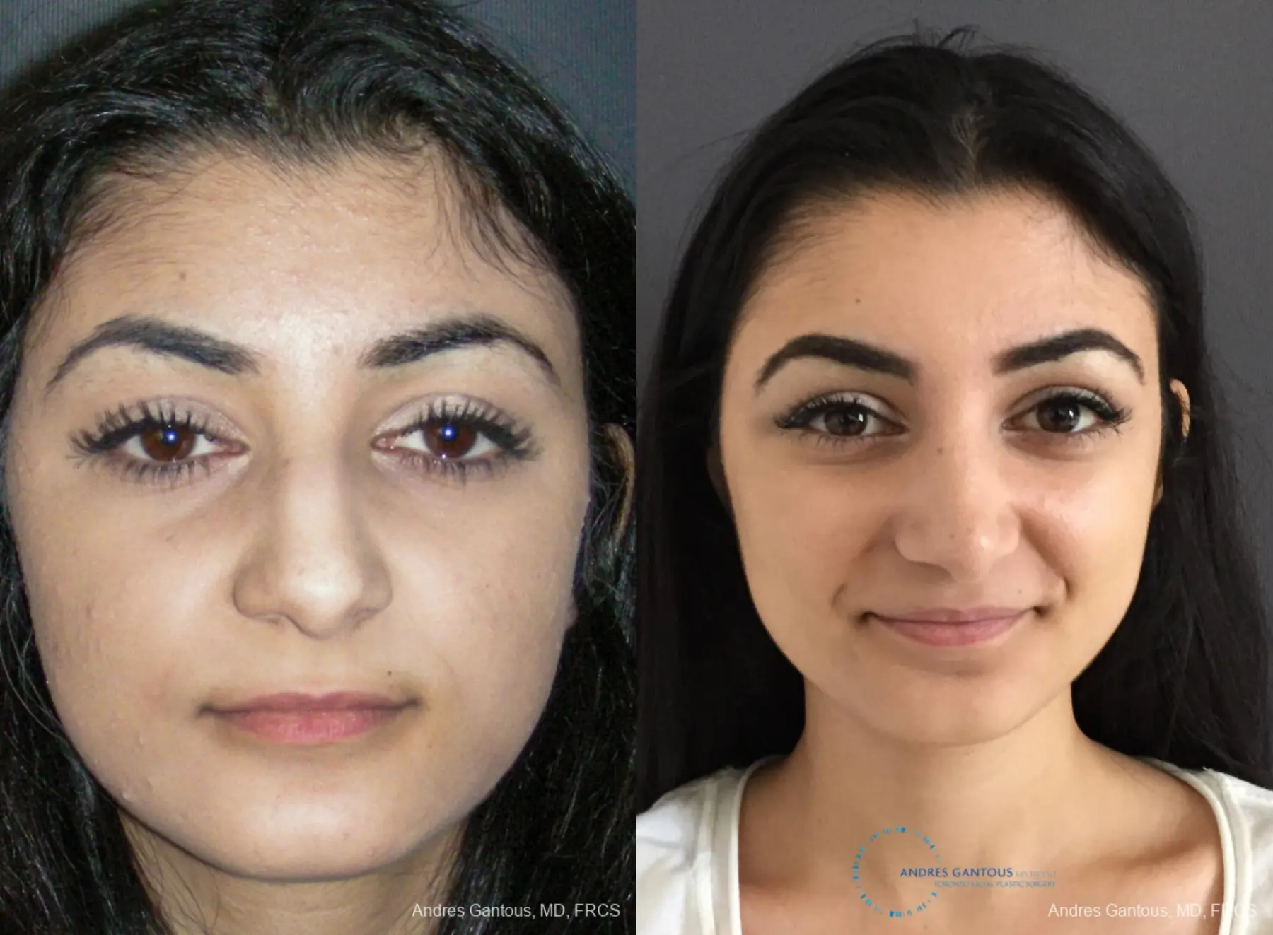 Rhinoplasty: Patient 87 - Before and After 1